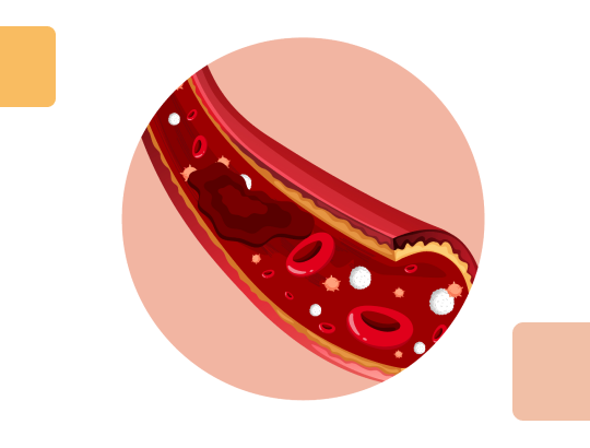 Новый калькулятор: Шкала Caprini